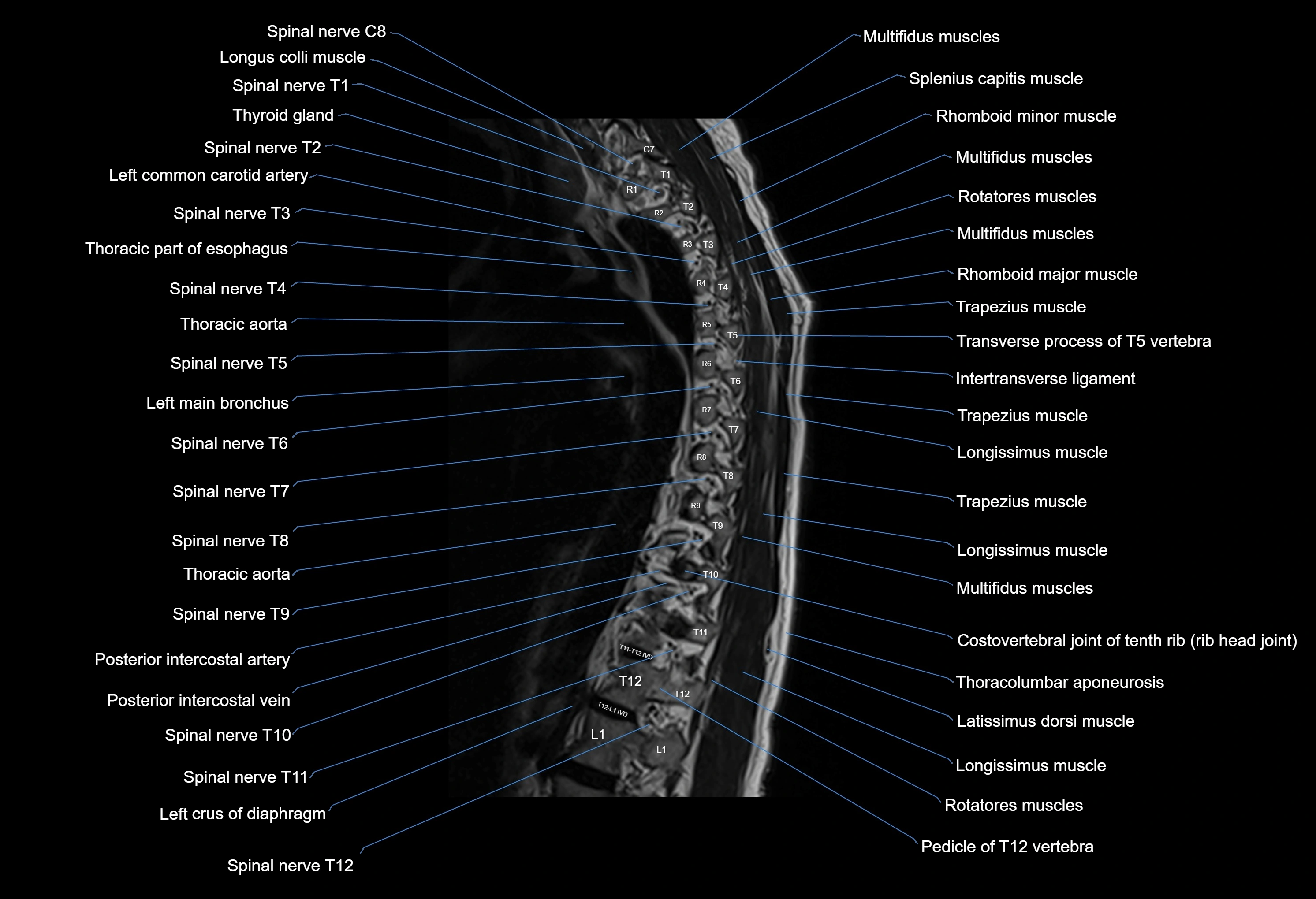 MRI thoracic spine sagittal  cross sectional anatomy 3T radiology  image-img-00001-00020.webp